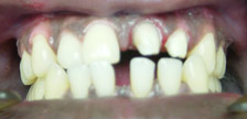 Orange New Jersey porcelain crowns image