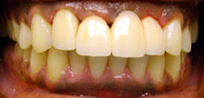 Orange New Jersey dental implants image