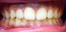 Orange New Jersey invisalign braces image