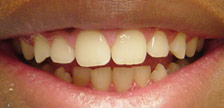 Orange New Jersey invisalign braces image