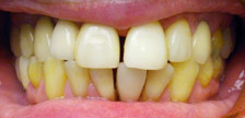 Orange New Jersey dental implants image