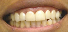 Orange New Jersey porcelain veneers image