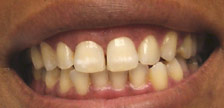 Orange New Jersey porcelain veneers image