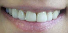 Orange New Jersey porcelain veneers image