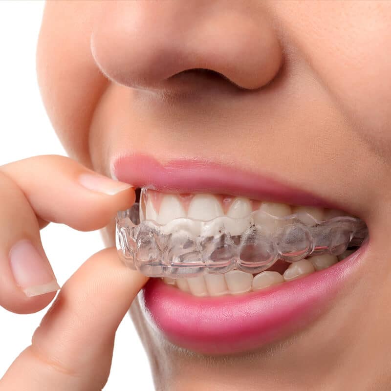 Invisalign and Braces