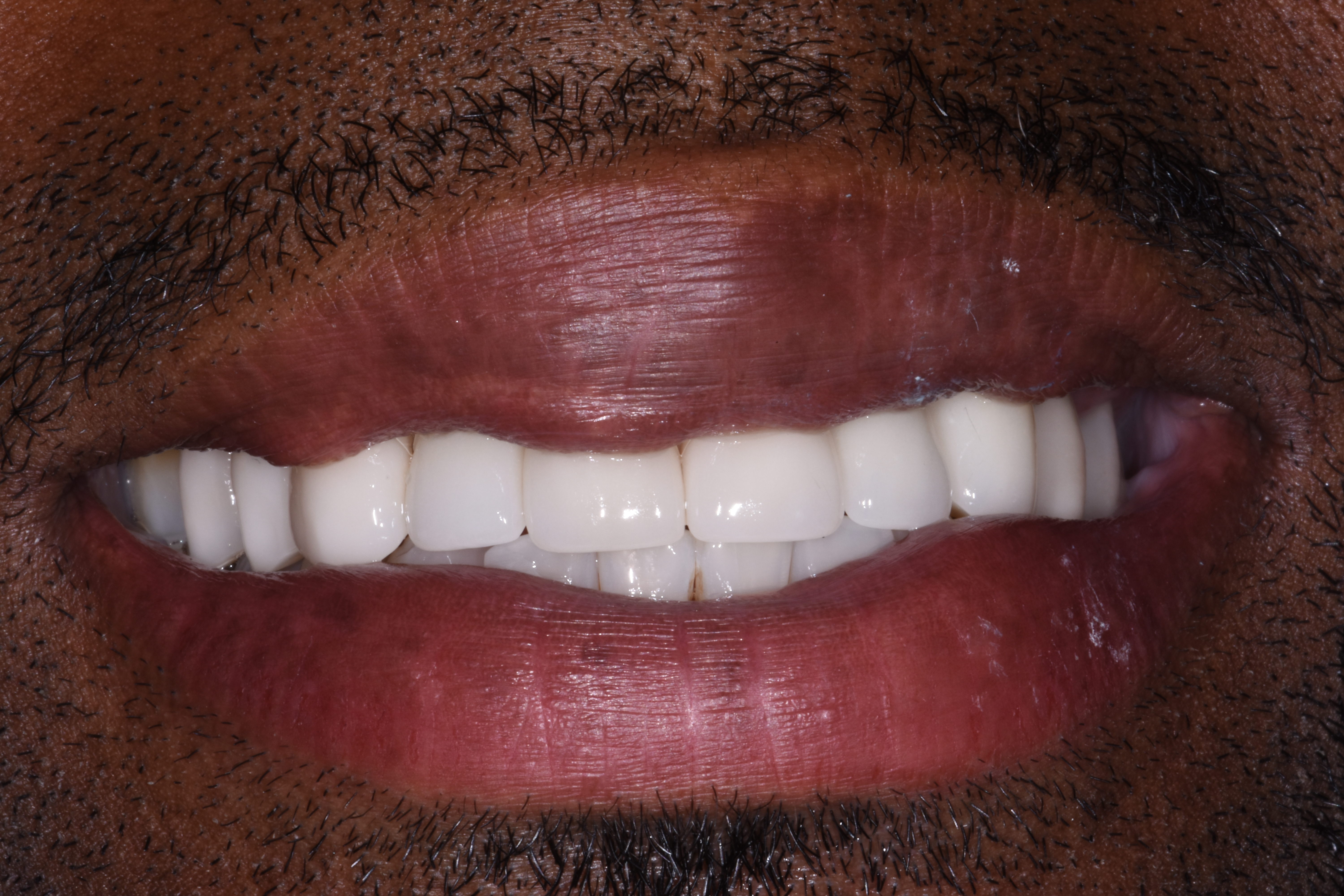 Porcelain crowns after