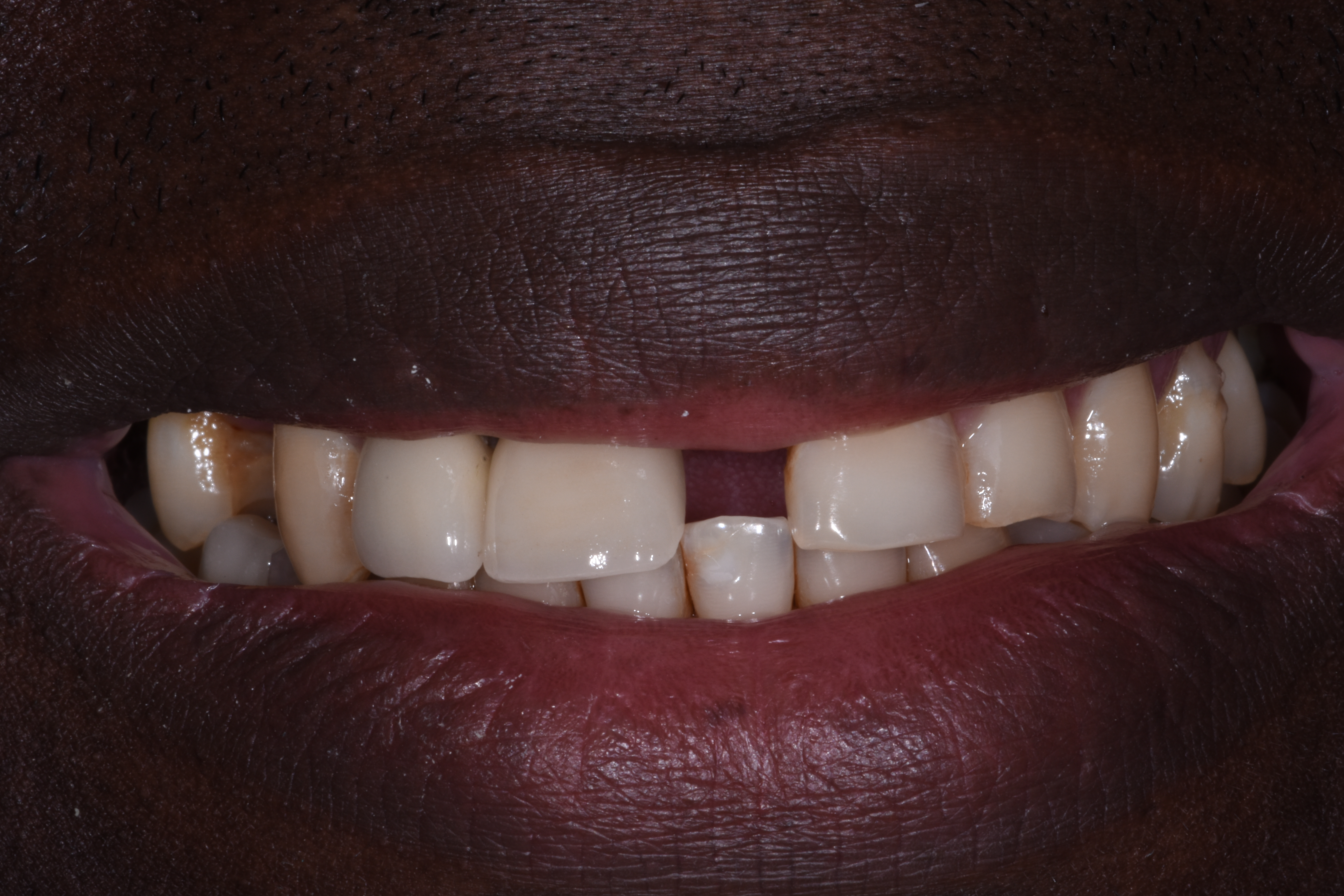  Porcelain veneers 