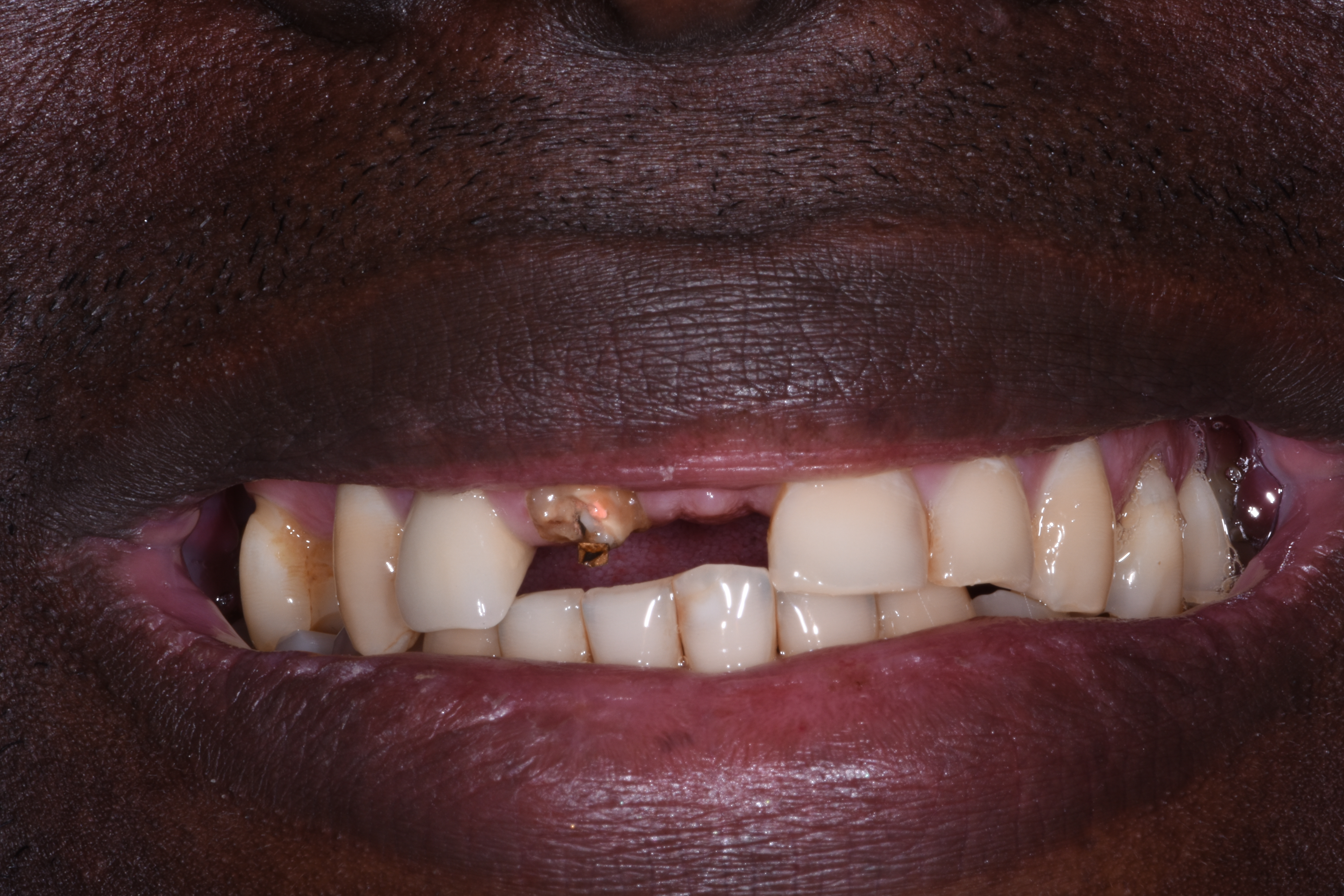 Porcelain veneers