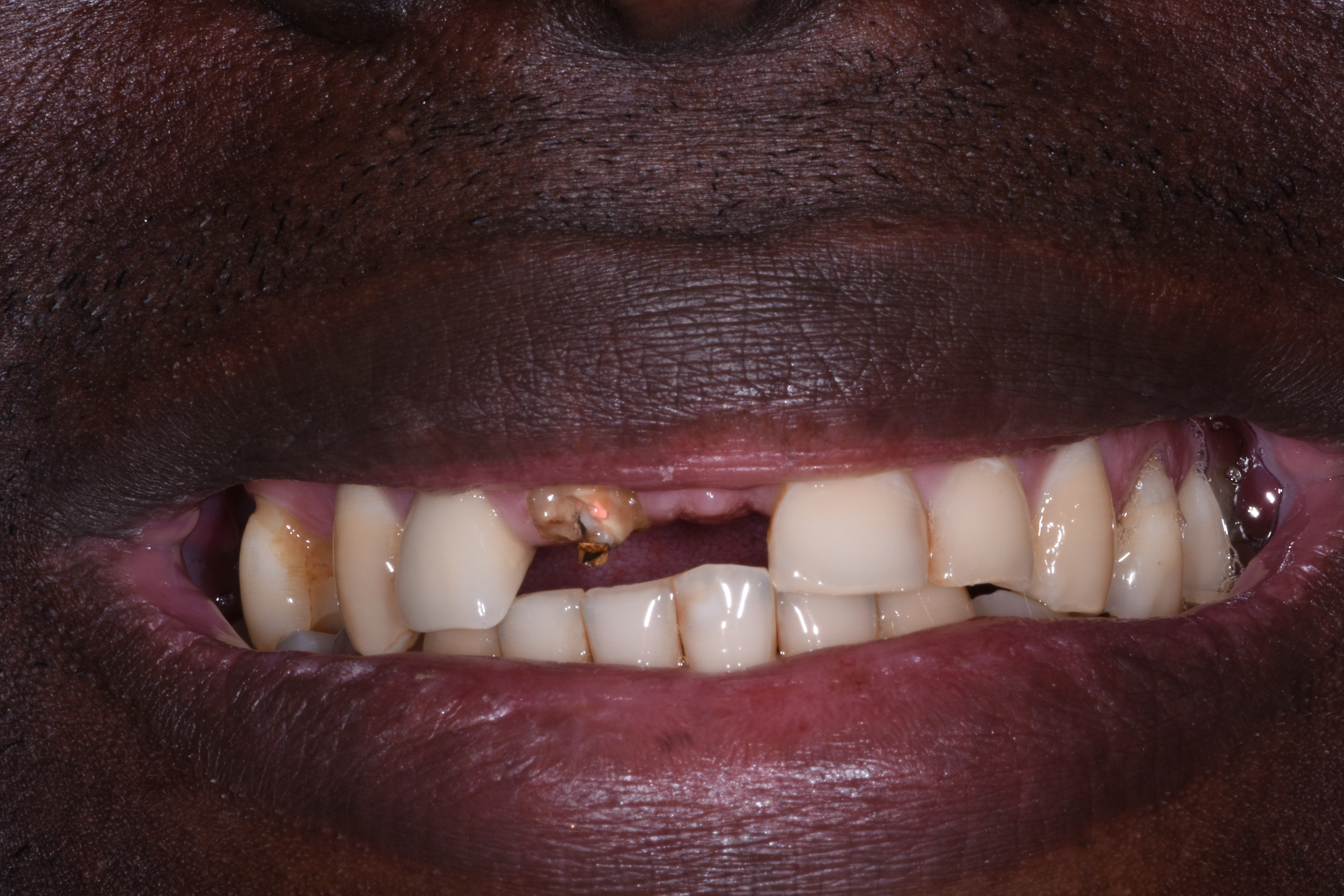 Porcelain veneers 