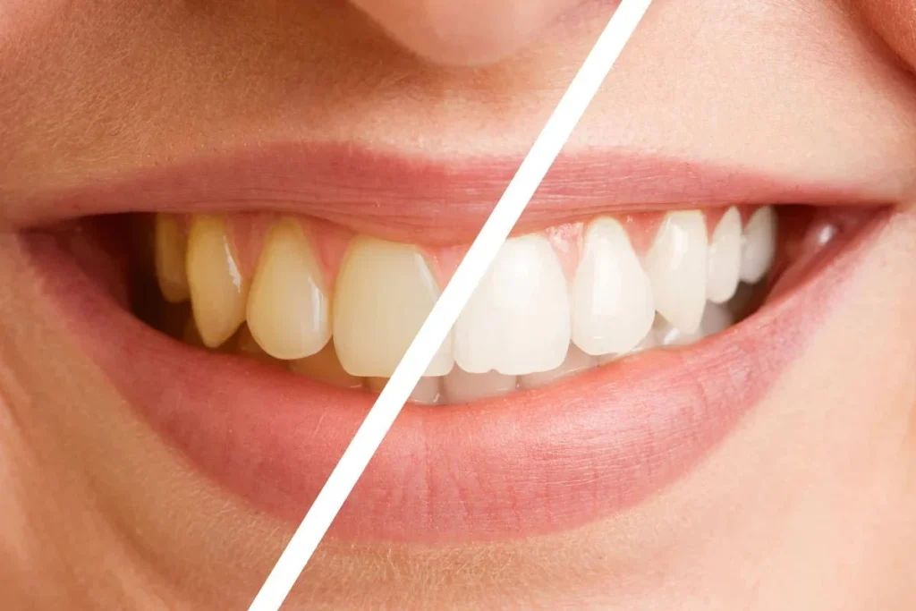 Zoom Whitening